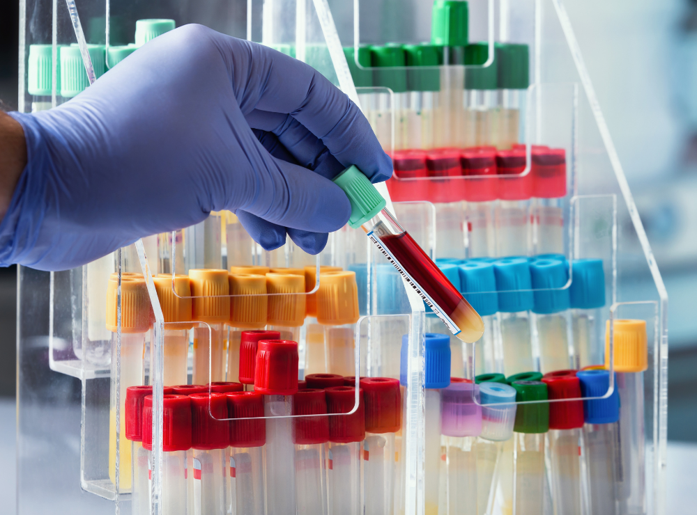 New blood test for Alzheimer’s Disease diagnosis